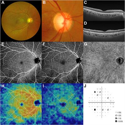 Case Report: Recanalization of Branch Retinal Artery Occlusion Due to Microthrombi Following the First Dose of SARS-CoV-2 mRNA Vaccination